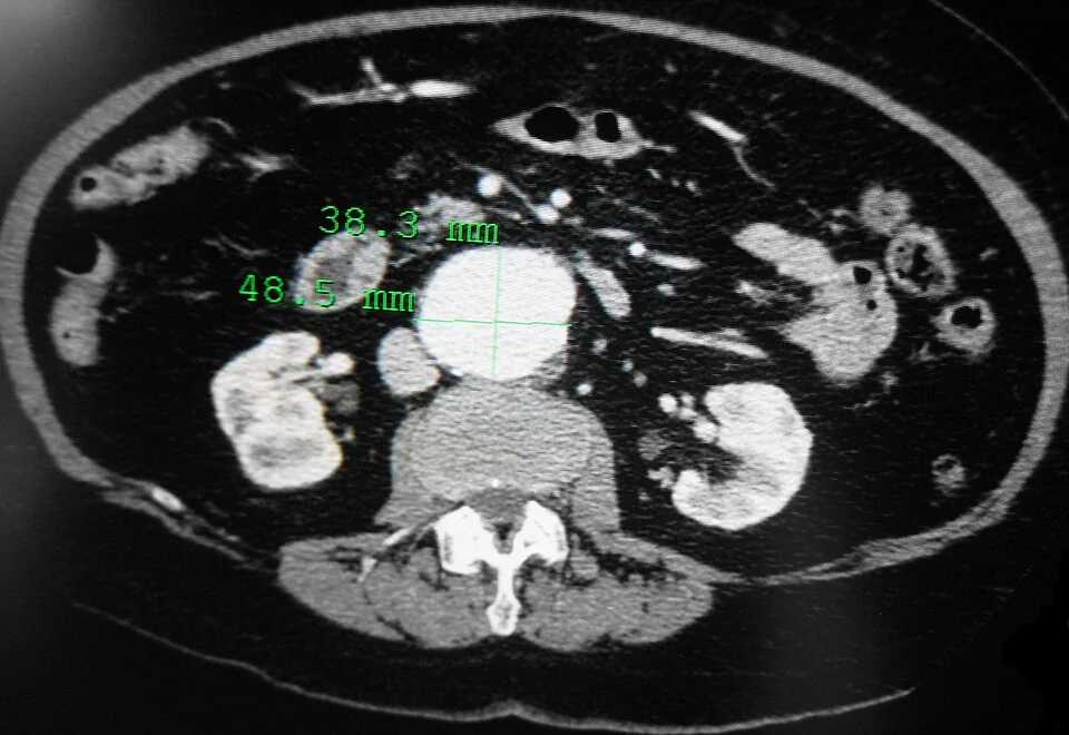 Axial contrast-enhanced CT slice of the abdomen showing a markedly dilated abdominal aorta with a bright contrast-filled central lumen surrounded by a rim of lower-density mural thrombus.