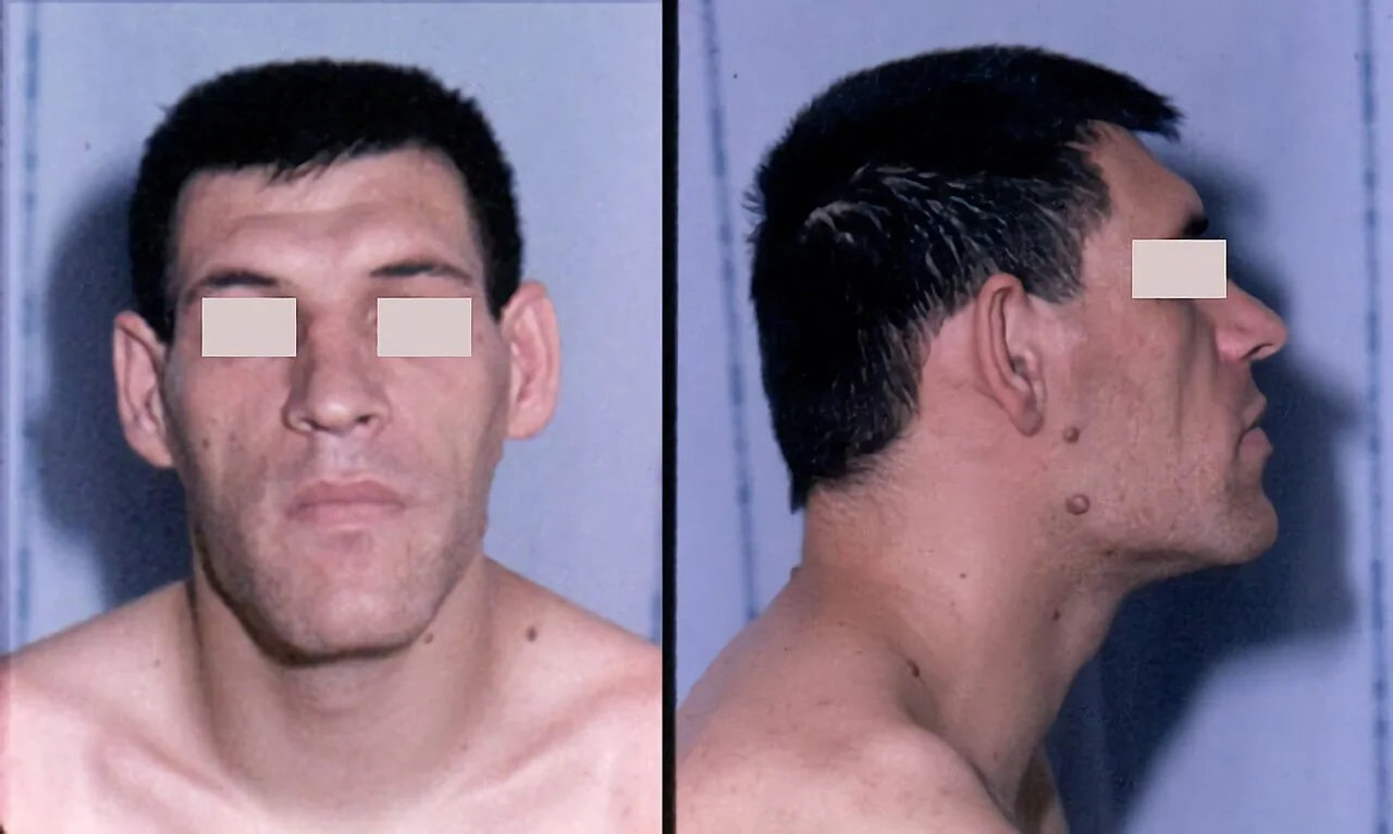Frontal photograph of a patient with acromegaly showing coarsened facial features, a widened and thickened nose, prominent cheekbones and thickened lips.