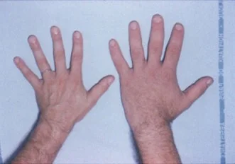 Photograph of enlarged, broad, spade-like hands with thickened doughy skin in a patient with acromegaly.
