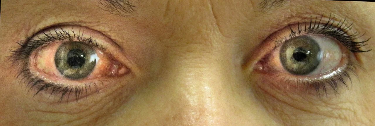 Photograph comparing two eyes: the right eye shows marked conjunctival redness with a hazy cornea and a mid-dilated pupil that did not react to light, while the left eye is normal.