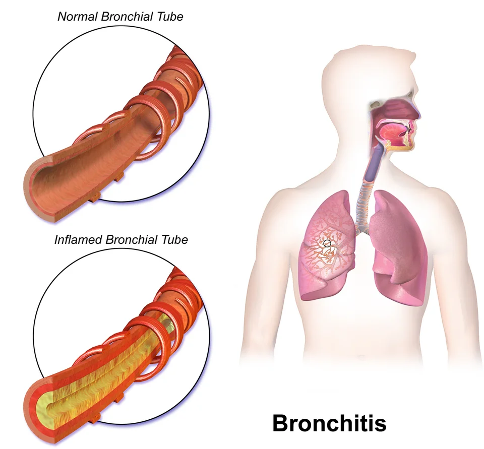 Medical illustration comparing a cut-away normal bronchial tube with an open lumen and a smooth lining against an inflamed bronchial tube with a reddened, swollen wall and yellow mucus filling the lumen, alongside a torso diagram showing the airways.