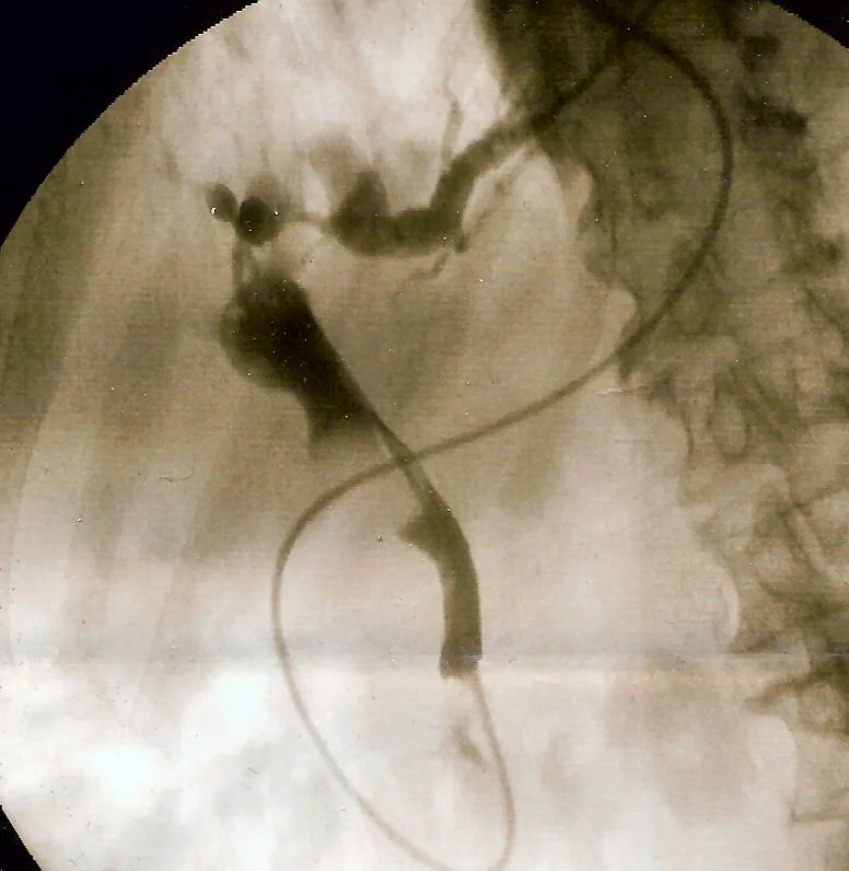 Fluoroscopic image taken during ERCP showing a contrast-filled biliary tree with a rounded filling defect impacted in the distal common bile duct.