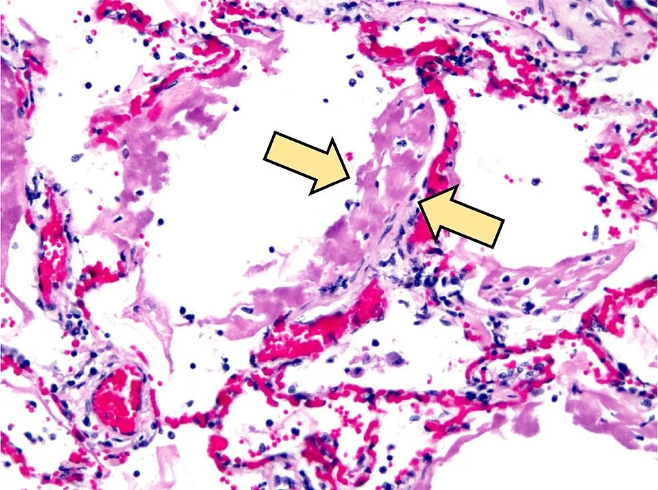 Haematoxylin and eosin micrograph of lung tissue with two arrows indicating thick, glassy, pink eosinophilic membranes lining the alveolar walls, alongside congested capillaries and scattered inflammatory cells.