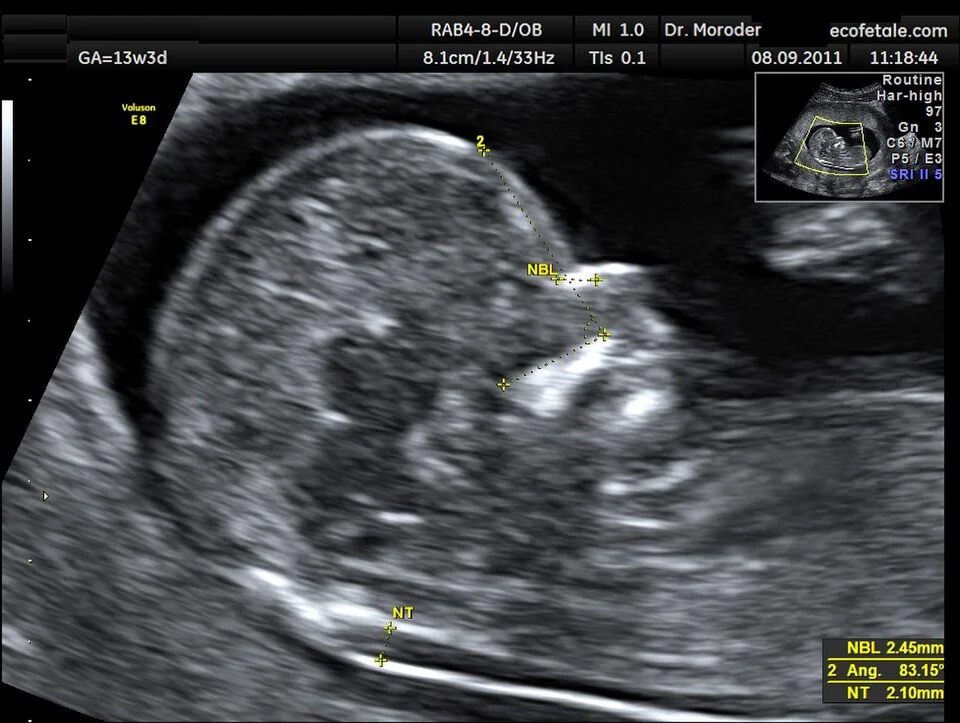 Midsagittal ultrasound image of a first-trimester fetus with calliper measurement of the nuchal translucency behind the fetal neck.