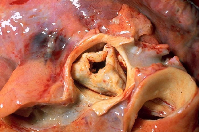 Post-mortem specimen viewed from above with the aorta removed, showing thickened, fused aortic valve leaflets narrowing the valve orifice, alongside the openings of the coronary arteries.
