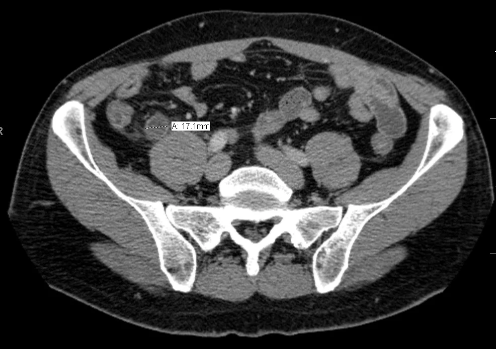 Axial CT slice of the abdomen showing a thickened, fluid-filled tubular structure in the right iliac fossa measuring 17.1 mm in diameter, with surrounding fat stranding, consistent with acute appendicitis.