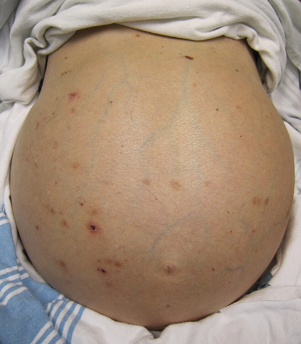 Photograph of a markedly distended abdomen with ascites and prominent superficial abdominal veins in a patient with liver failure.
