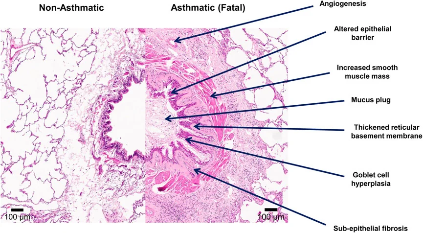 Side-by-side histology of a non-asthmatic and a fatal asthmatic airway, with labels pointing to angiogenesis, an altered epithelial barrier, increased smooth muscle mass, a mucus plug, a thickened reticular basement membrane, goblet cell hyperplasia and sub-epithelial fibrosis.