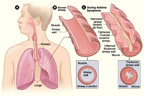 Medical illustration showing the lungs and airways, a cross-section of a normal bronchiole with an open lumen, and a cross-section of an airway during asthma symptoms showing tightened smooth muscle, a thickened inflamed airway wall and mucus narrowing the lumen.