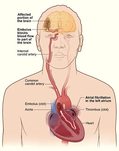 Diagram of the head, neck and heart showing thrombus forming in the fibrillating left atrium, an embolus travelling up the common and internal carotid arteries, and the resulting area of affected brain where the embolus blocks blood flow.
