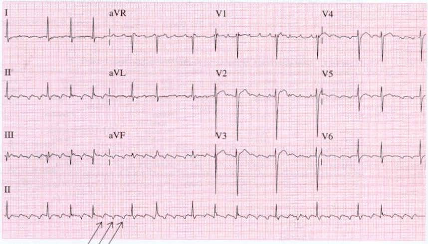 A 12-lead ECG in atrial flutter with a lead II rhythm strip beneath it, on which three arrows point to successive sawtooth flutter waves occurring between the QRS complexes.