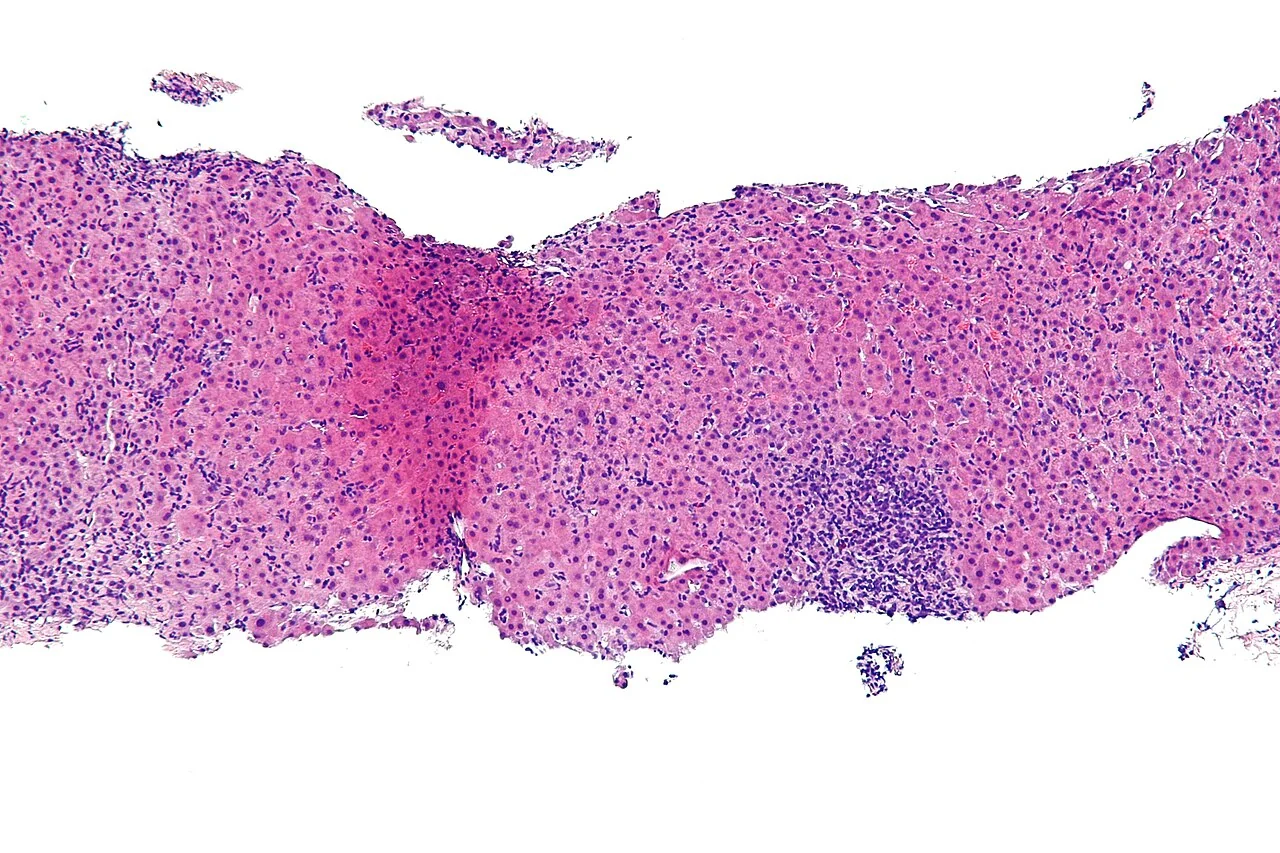 Liver biopsy histology in autoimmune hepatitis showing a dense portal inflammatory infiltrate with lymphocytes and plasma cells extending across the limiting plate into the adjacent lobule.