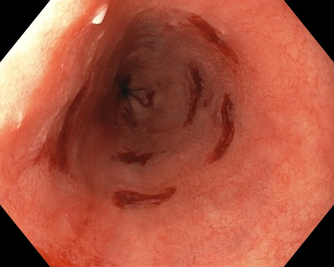 Endoscopic image of the distal oesophagus showing salmon-coloured Barrett's mucosa with biopsy sites marked according to the Seattle protocol.