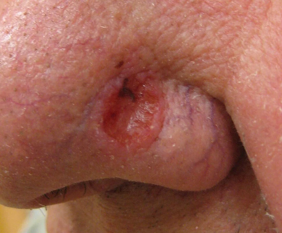 Close-up photograph of a nodular basal cell carcinoma on the nose, showing a pearly, rolled edge with visible telangiectasia and a central ulcerated, crusted area.