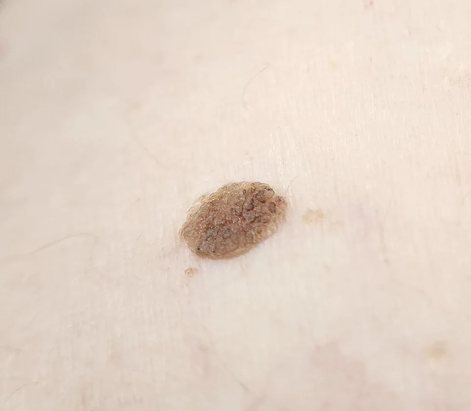 Close-up photograph of a seborrhoeic keratosis, showing a well-demarcated, raised, warty, brown papule with a rough, 'stuck-on' surface.