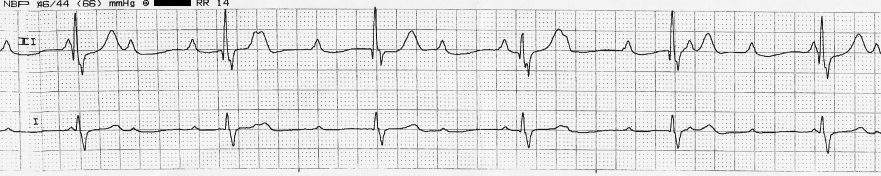 A two-lead ECG rhythm strip showing regular P waves at one rate and slower QRS complexes at an entirely independent rate, with no consistent relationship between them and P waves visible within and after some QRS complexes.