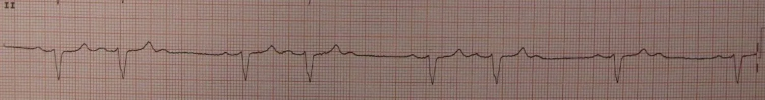 An ECG rhythm strip in lead II showing regular P waves with a constant PR interval before each conducted beat, with occasional P waves that are not followed by a QRS complex at all.