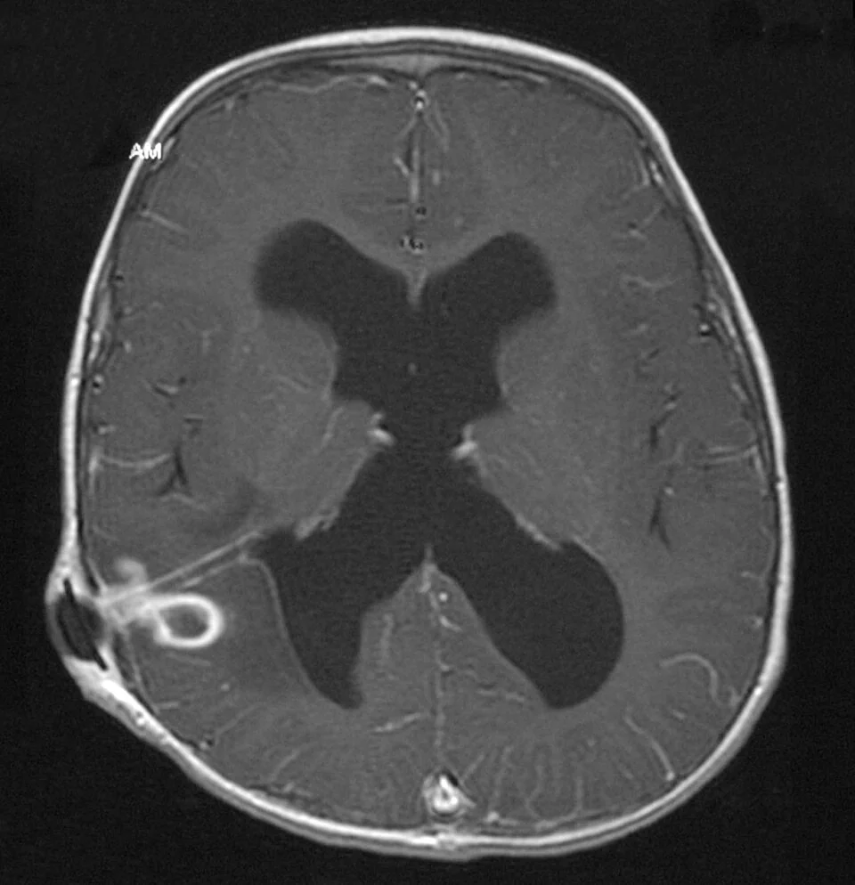 Axial T1-weighted contrast-enhanced MRI brain scan showing a small, well-defined ring-enhancing lesion in the right posterior region with surrounding low-signal oedema, adjacent to a ventricular catheter, with dilated lateral ventricles.