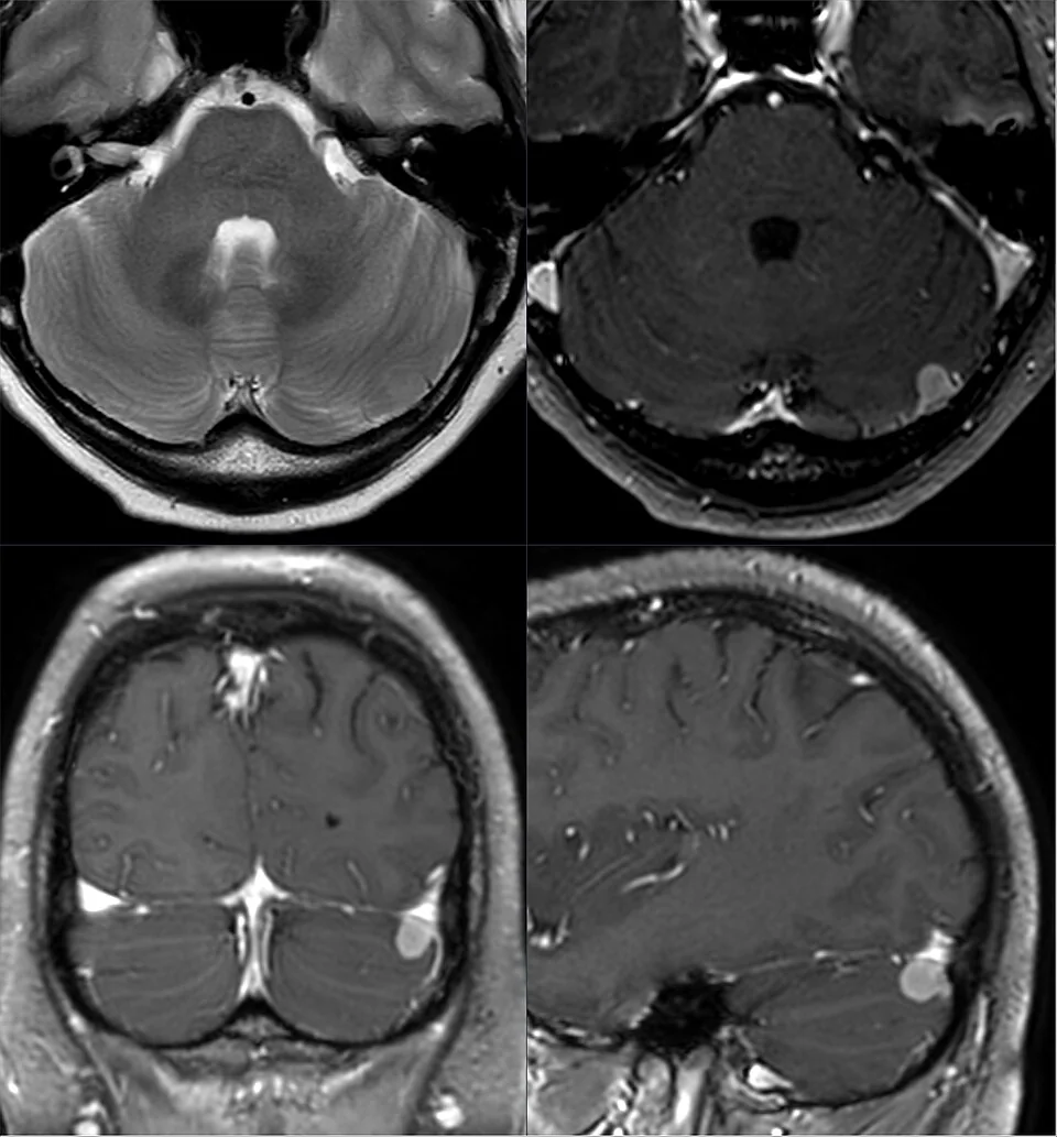 Four-panel MRI of the brain showing a small, well-defined, avidly enhancing extra-axial mass adjacent to the tentorium on the left, seen on axial T2, axial post-contrast T1, and coronal and sagittal post-contrast T1 images.