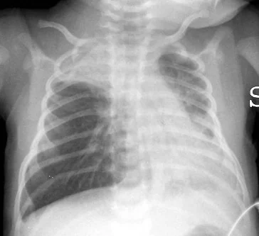 Chest radiograph of a young infant showing hyperinflated lungs with flattened diaphragms and patchy areas of collapse at the right apex and left base.