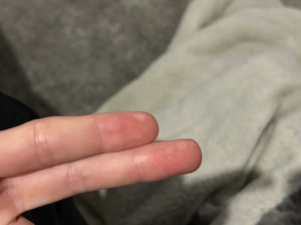 Close-up photograph of a finger showing small, fluid-filled blisters with surrounding erythema, typical of a superficial partial-thickness burn.