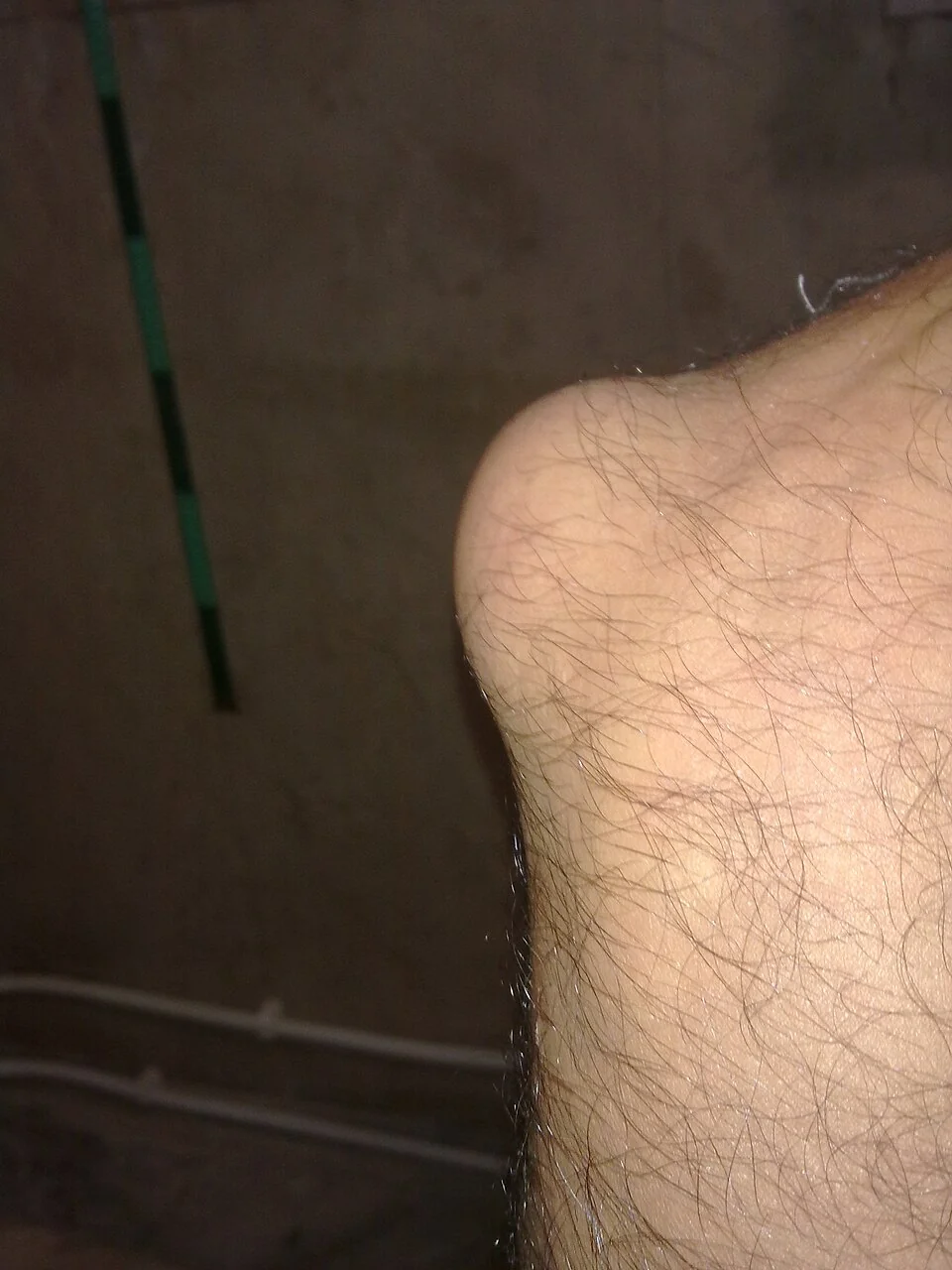 Photograph of a flexed elbow showing a rounded, well-circumscribed soft tissue swelling confined to the tip of the olecranon, without erythema spreading into the surrounding forearm or upper arm.