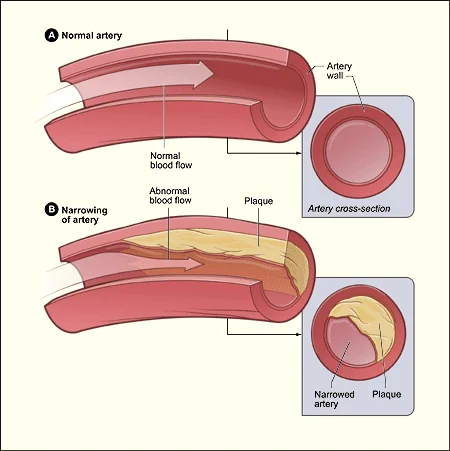 Two cross-sections of an artery side by side. Figure A shows a normal artery with an open lumen and unobstructed blood flow. Figure B shows an artery narrowed by plaque built up within the wall, restricting the lumen.