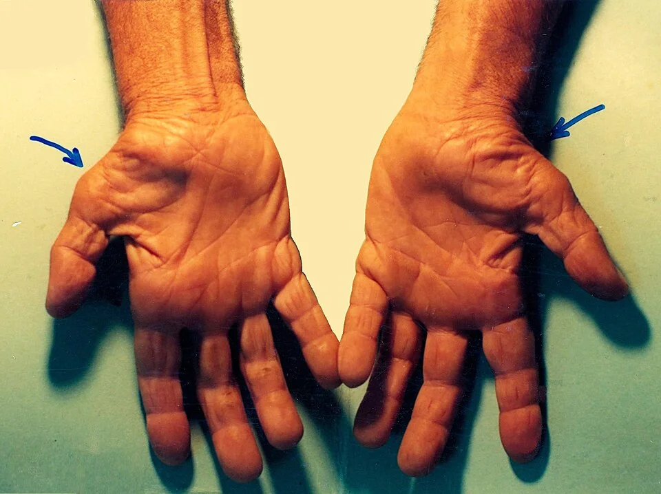 Both palms held side by side, with arrows indicating the thenar eminences at the base of each thumb, which appear flattened and hollowed compared with the bulk of the hypothenar eminences.