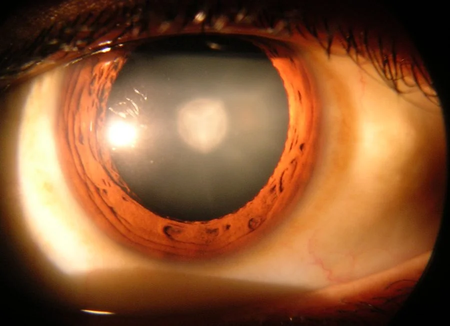 Close-up photograph of a human eye with a dense white cataract, the pupil appearing white rather than black because the opacified lens sits immediately behind it.