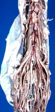 Anterior view of a dissected human caudal spinal cord specimen, labelled to show the conus medullaris where the cord tapers and ends, the thread-like filum terminale descending from it, and the surrounding sheaf of lumbosacral nerve roots forming the cauda equina.