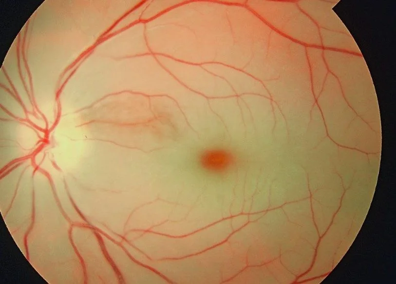 Colour fundus photograph showing central retinal artery occlusion, with a diffusely pale, swollen retina at the posterior pole and a bright red spot at the centre of the macula, with attenuated retinal arterioles.