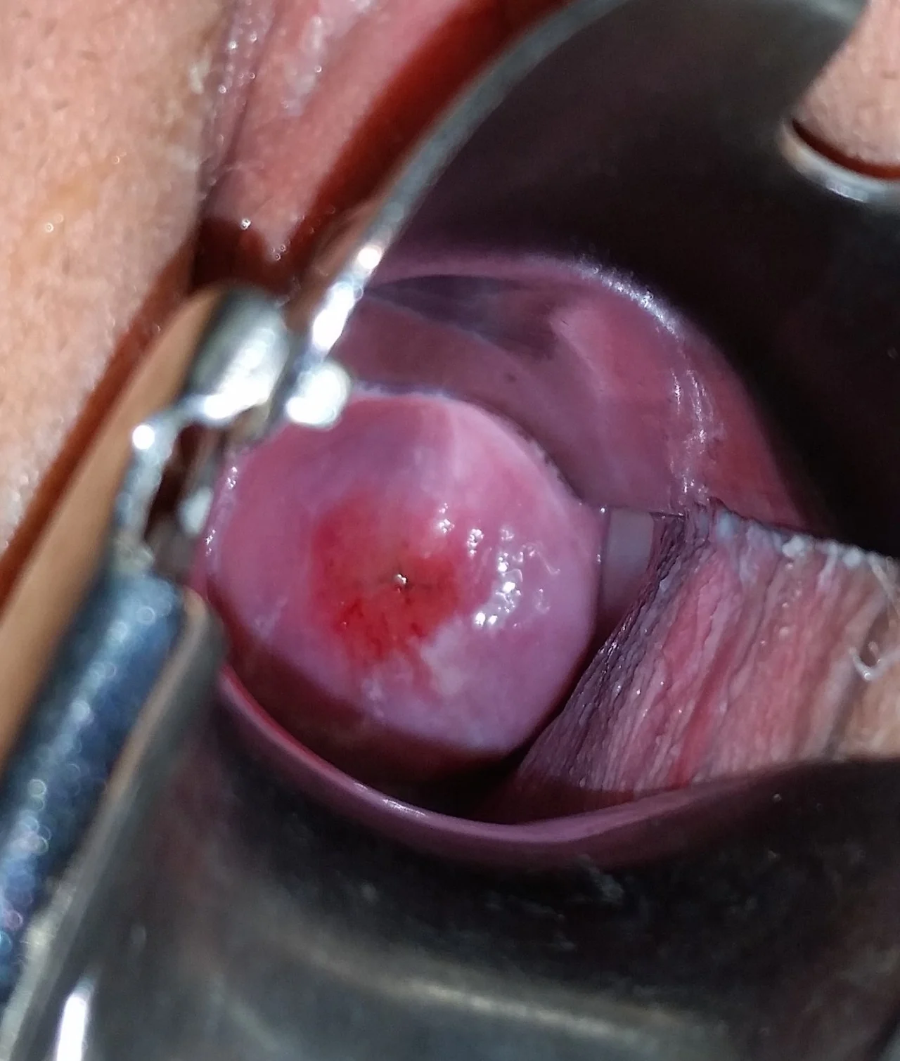 Speculum examination photograph of the cervix showing a well-demarcated red, velvety area of columnar epithelium (ectropion) surrounding the external os, contrasting with the paler squamous epithelium.