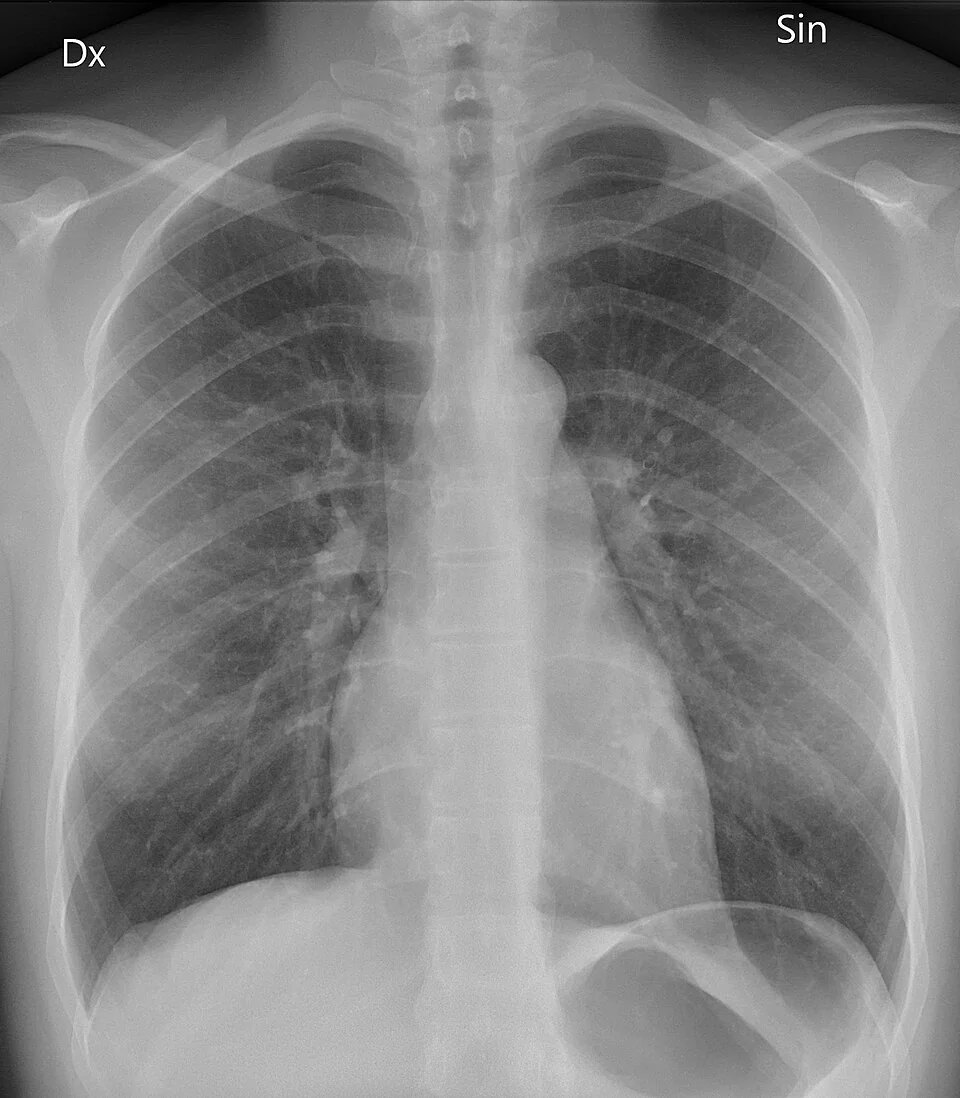 A normal posteroanterior chest radiograph of a young adult showing symmetrical clear lung fields, a central trachea, a normal-sized heart occupying less than half the thoracic width, sharp costophrenic angles, smooth domed hemidiaphragms with the right slightly higher than the left, and a gastric air bubble beneath the left hemidiaphragm.