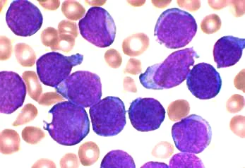 Stained bone marrow smear under high magnification showing a dense population of large immature cells with scanty cytoplasm and prominent nuclei.