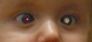 Photograph of a young child's face in which one pupil reflects white rather than the normal red, while the other eye shows a normal red reflex.