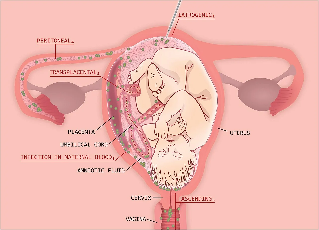 Diagram of the uterus showing ascending, transplacental, haematogenous, peritoneal and iatrogenic routes by which organisms reach the amniotic cavity.