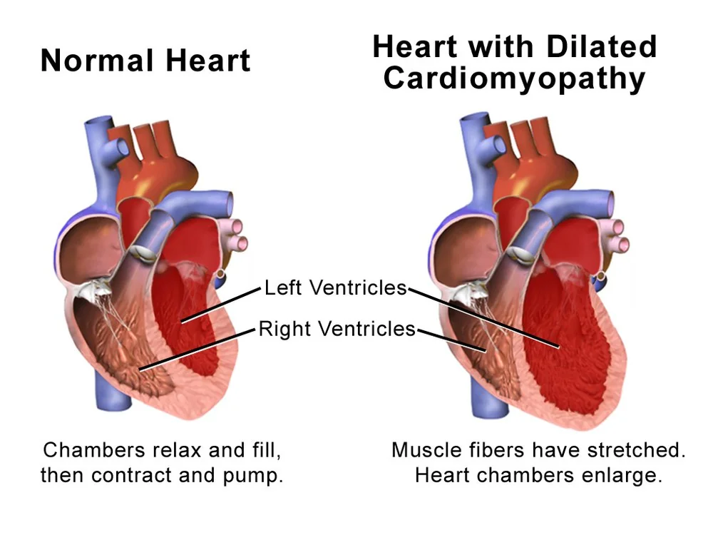 Cutaway illustration comparing a normal heart with one affected by dilated cardiomyopathy, in which the left ventricular cavity is enlarged and the wall is thinned.