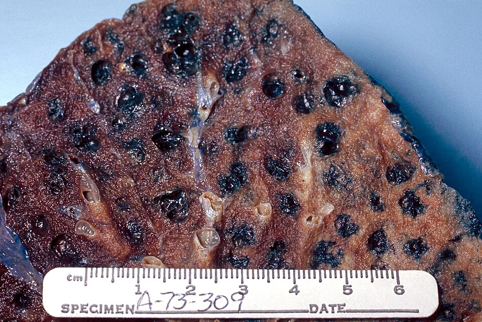 Cut surface of a lung specimen photographed next to a centimetre ruler, showing numerous enlarged airspaces up to several millimetres across, each lined by heavy black carbon deposits.