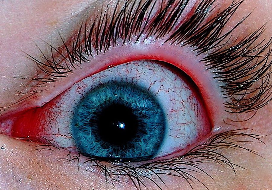 Close-up photograph of an eye with viral conjunctivitis showing diffuse redness of the bulbar conjunctiva, most marked away from the cornea, with a watery discharge and a clear cornea.