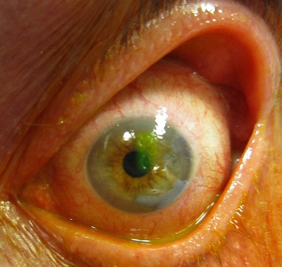 Photograph of an eye under cobalt blue light after fluorescein instillation, showing a bright green irregular area of staining on the cornea where the epithelium is missing, with the surrounding cornea unstained.