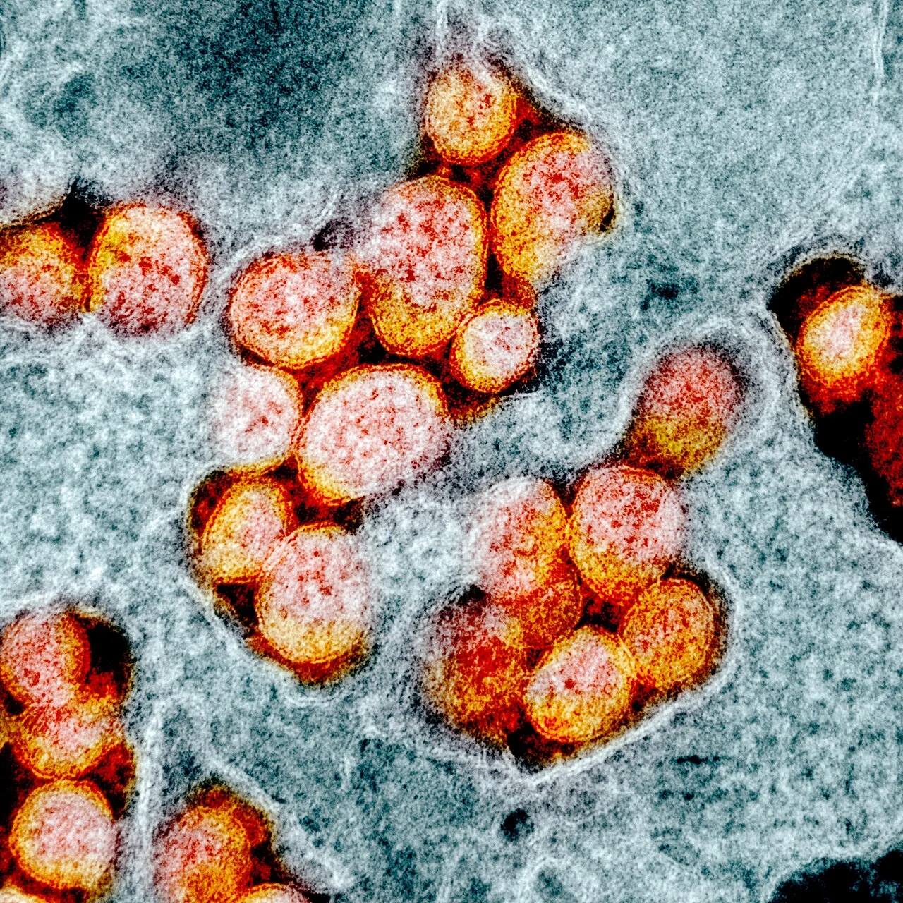 Colourised transmission electron micrograph showing spherical SARS-CoV-2 virus particles studded with spike proteins.