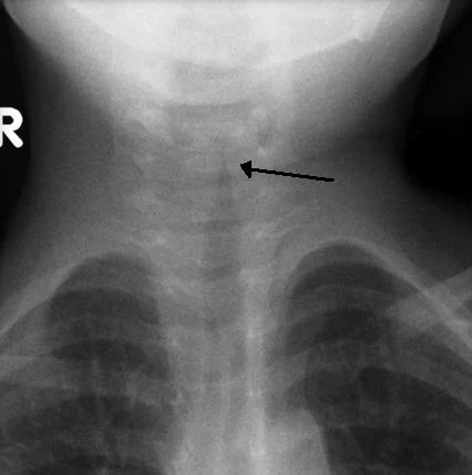 Anteroposterior radiograph of the neck in a child, showing the air column of the trachea tapering symmetrically to a narrow point just below the vocal cords, resembling a church steeple.