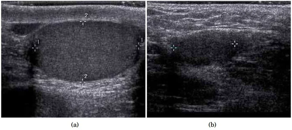 Two side-by-side scrotal ultrasound images: on the left a normally sized oval testis within the scrotum, on the right a smaller, less well-defined testis lying outside the scrotal sac.