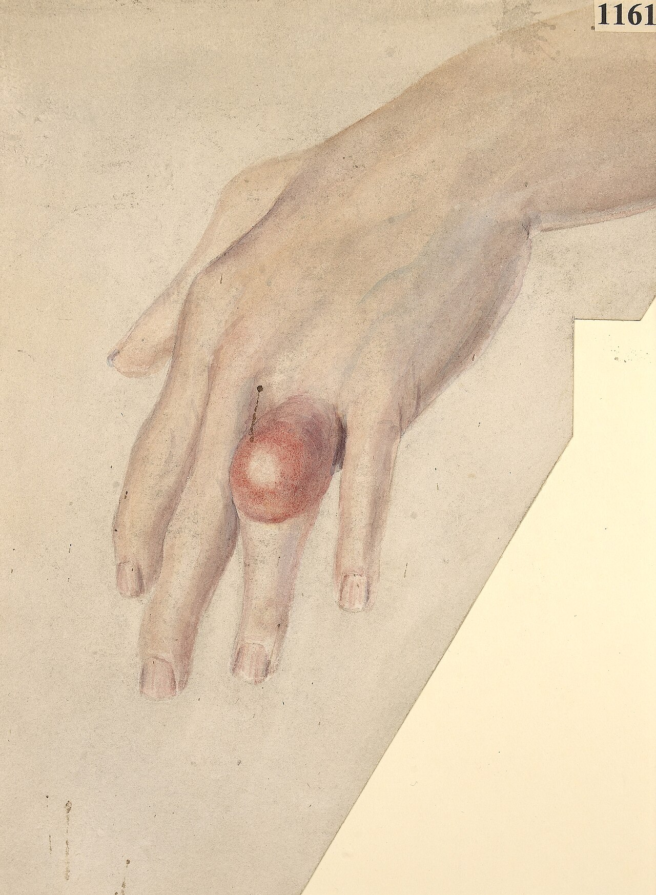 Photograph of a finger with a gouty tophus - a firm, pale, chalky subcutaneous nodule adjacent to the joint.