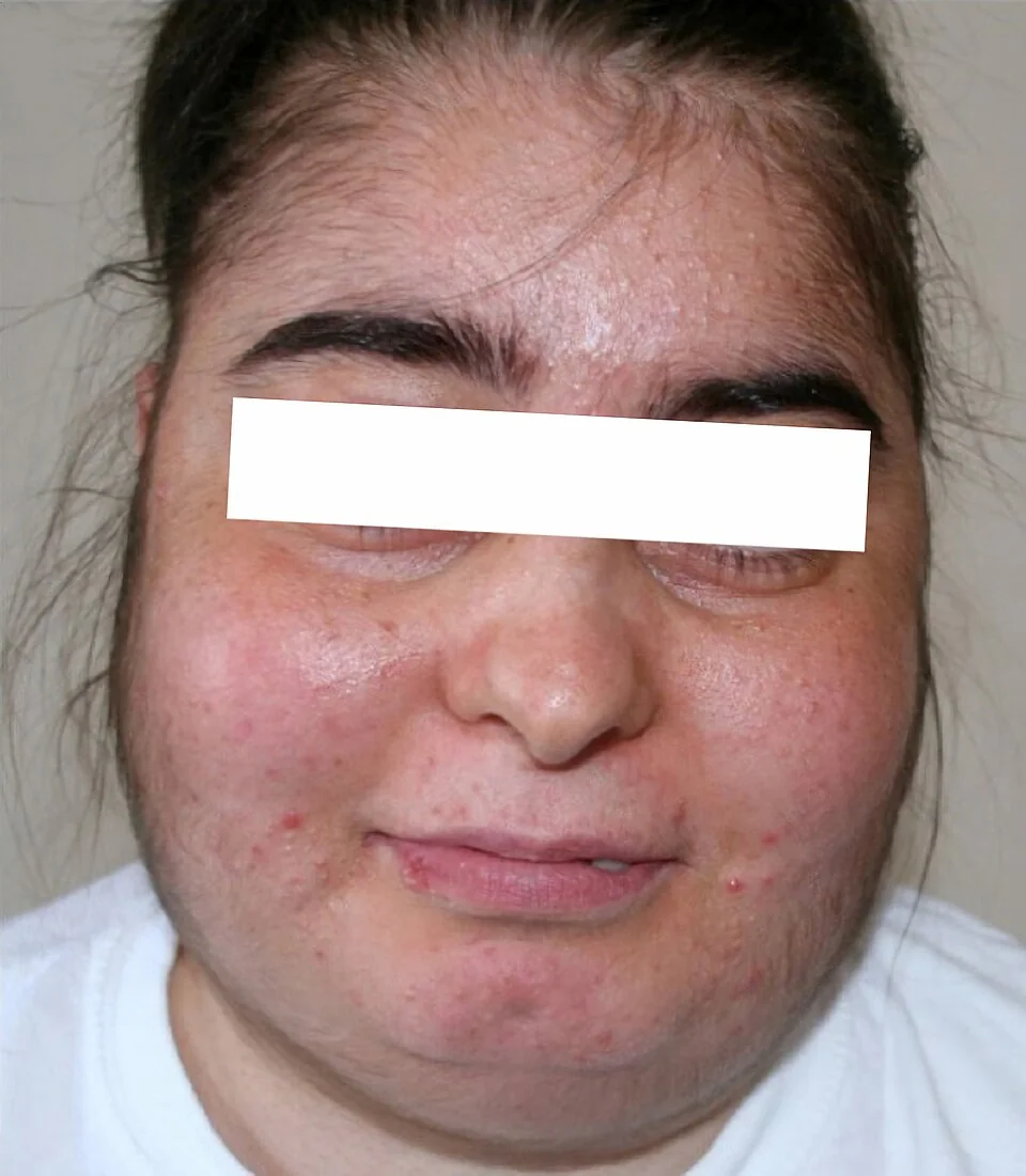Frontal photograph of a woman's face with the eyes masked, showing a rounded full face with fullness of the cheeks and submental region, marked facial redness, scattered acne and increased fine facial hair.