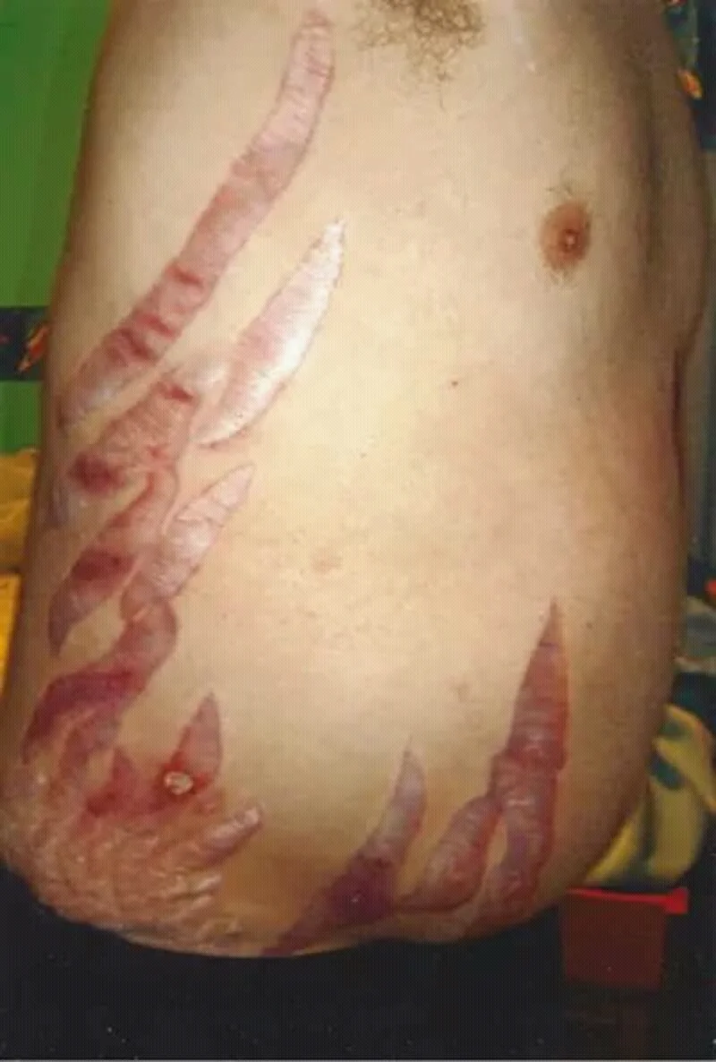 Photograph of the side of an abdomen showing multiple broad, deep purple-red stretch marks several centimetres long radiating across the flank, with a rippled surface.