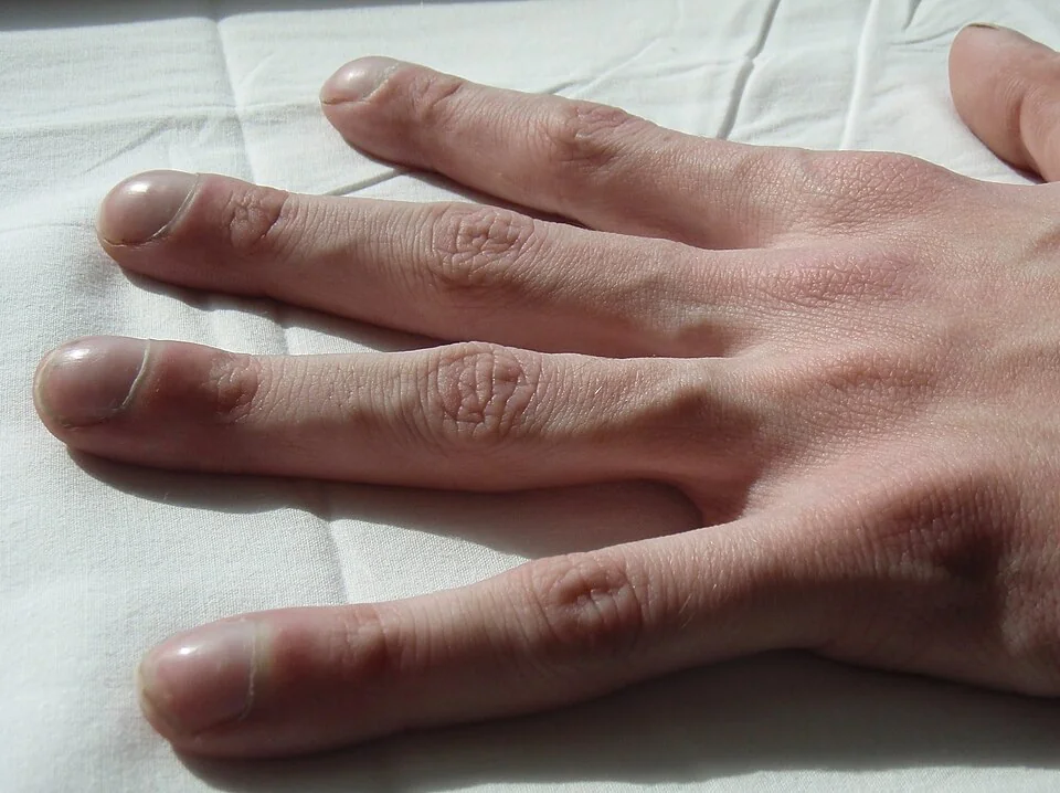 Close-up photograph of a hand resting on a white sheet showing marked finger clubbing, with bulbous fingertips, increased nail curvature and loss of the normal angle at the nail bed.