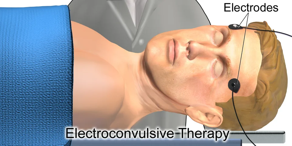 Illustration of a patient receiving electroconvulsive therapy under general anaesthesia, with electrodes placed on the head and monitoring equipment attached.