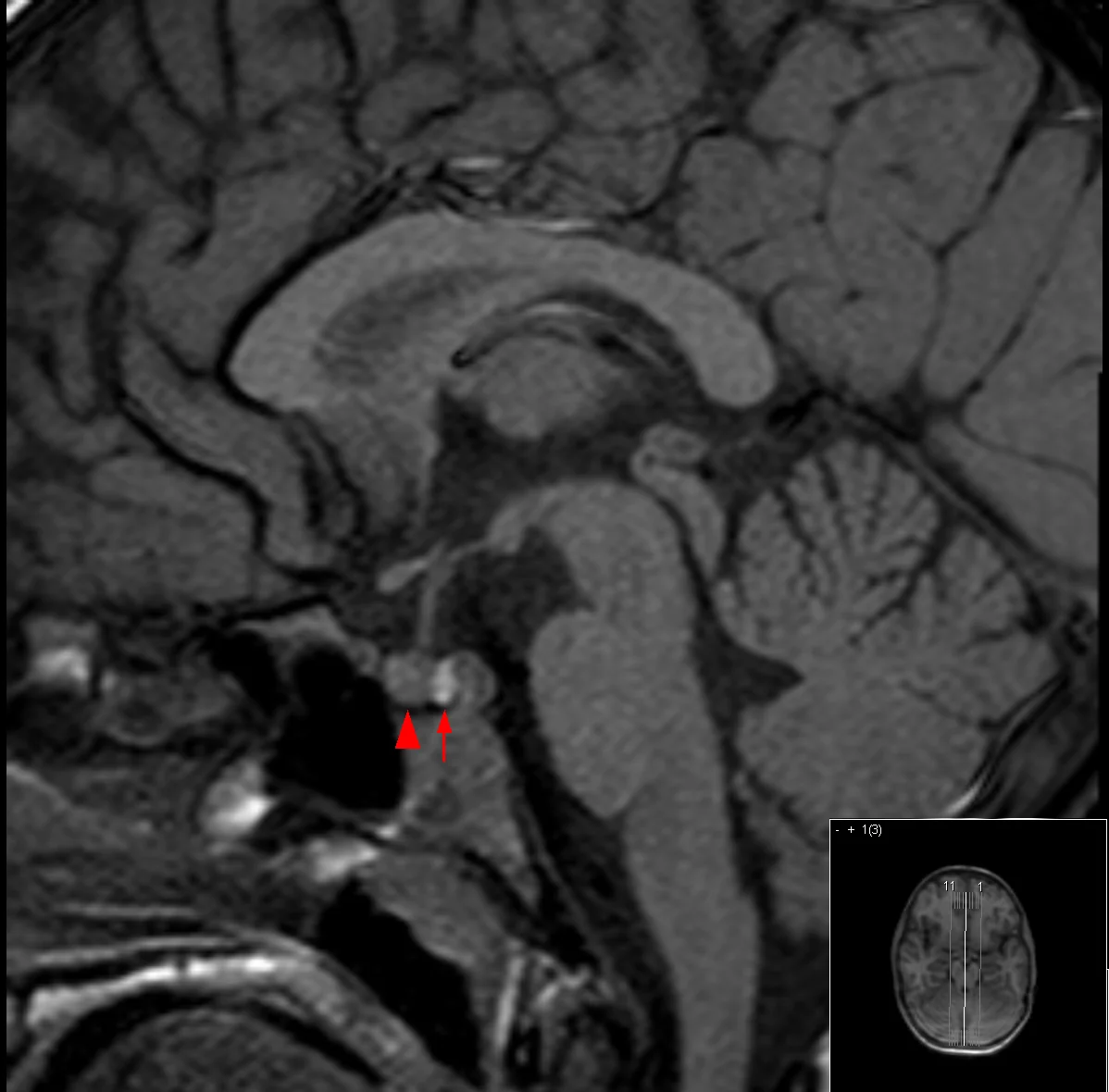 Sagittal unenhanced T1-weighted MRI of the brain showing the pituitary gland, with the posterior pituitary appearing as a bright signal (arrow) and the anterior pituitary indicated separately (arrowhead).