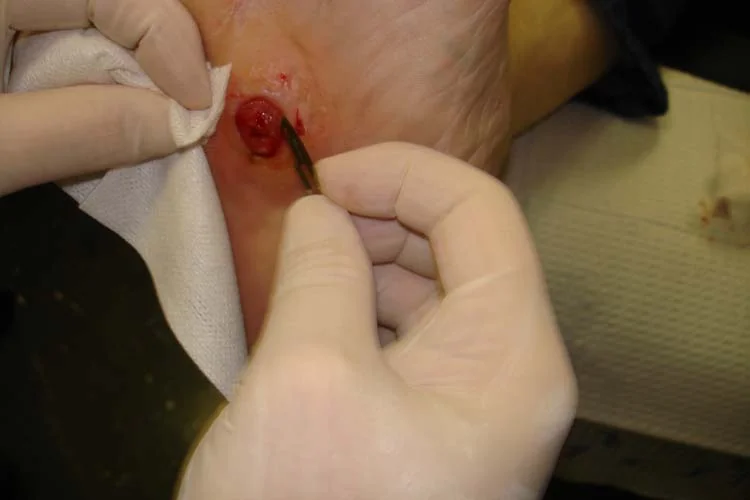 Gloved hands inserting a slim metal probe into a small deep ulcer on the plantar surface of a foot, with a gauze swab held against the adjacent skin.
